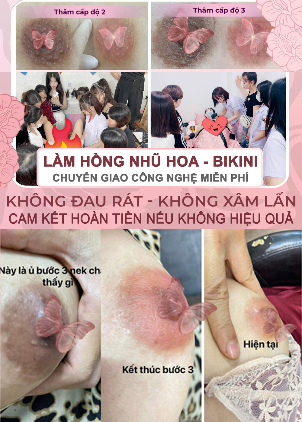 Làm hồng nhũ hoa - hồng bikini
